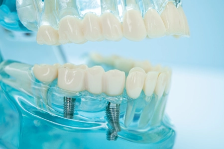 implantes-dentales-alaquas implantes dentales